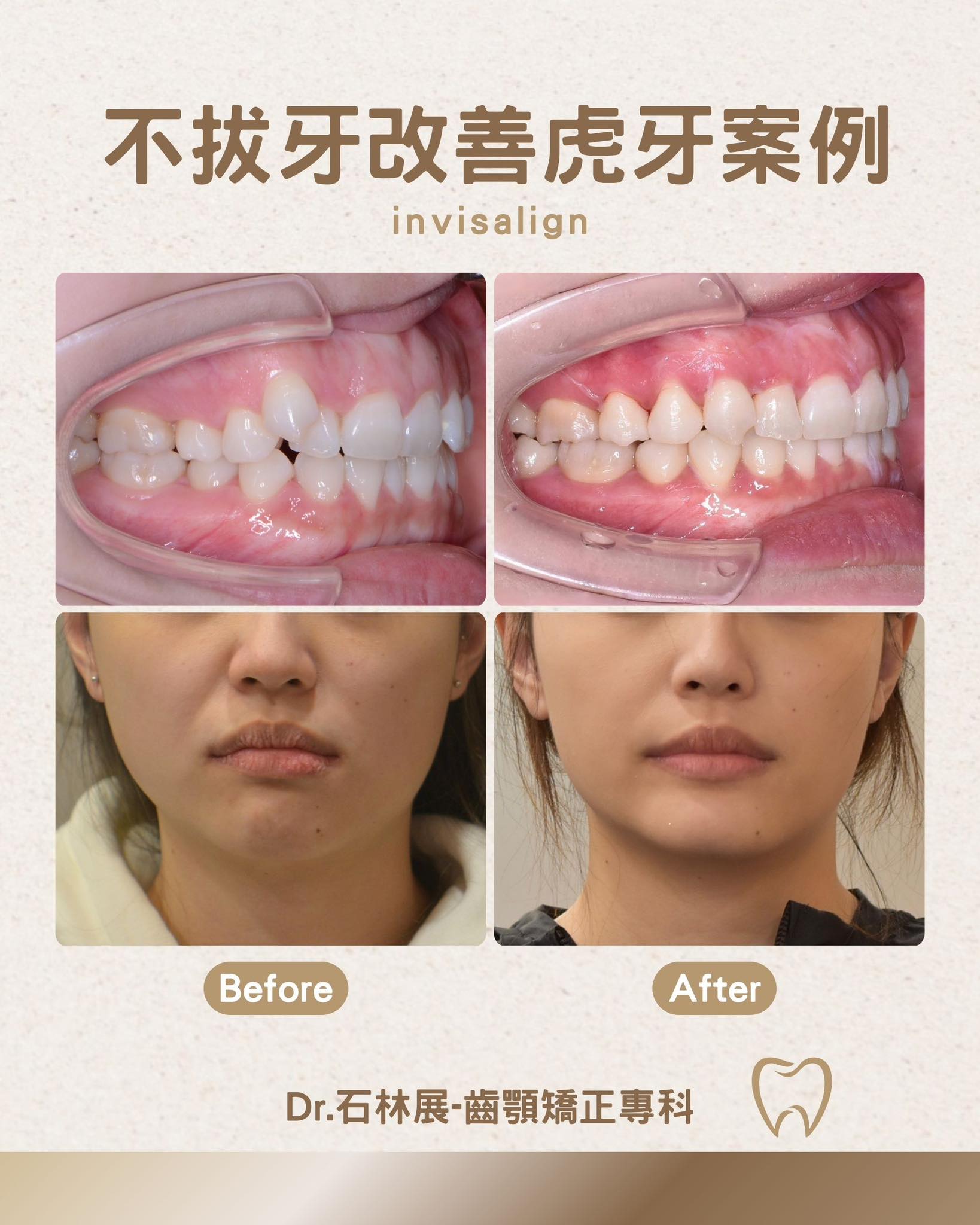 不拔牙齒也能改善虎牙的案例