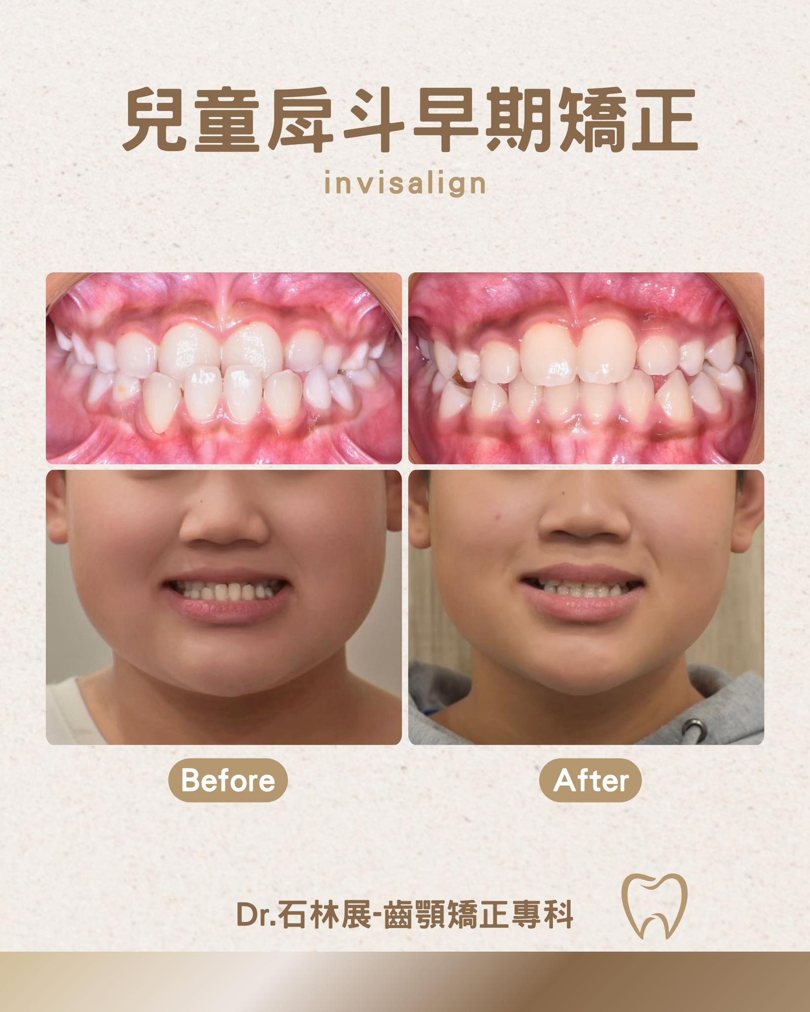 戽斗早期矯正案例