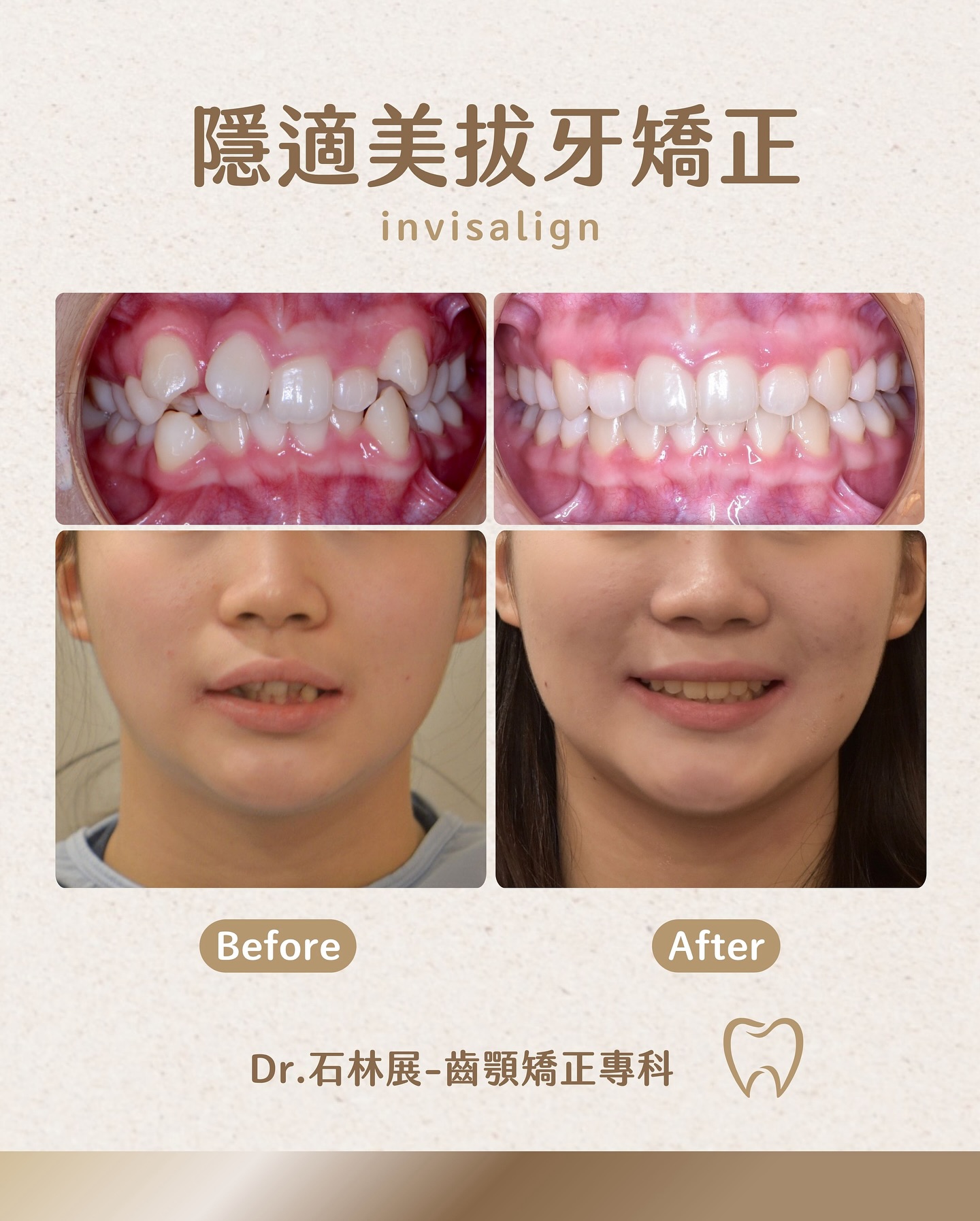 隱適美拔牙矯正案例