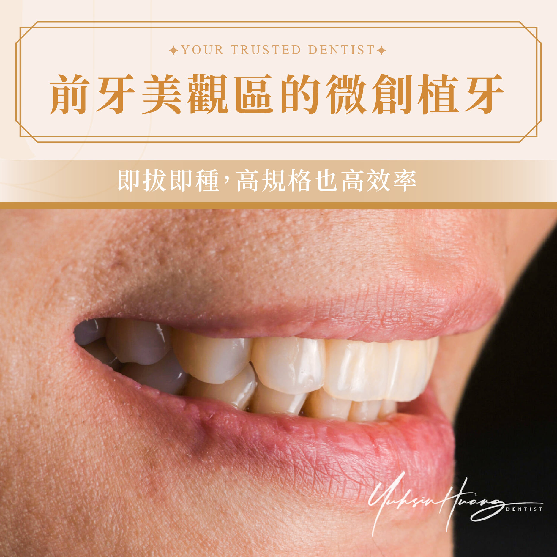 即拔即種微創植牙