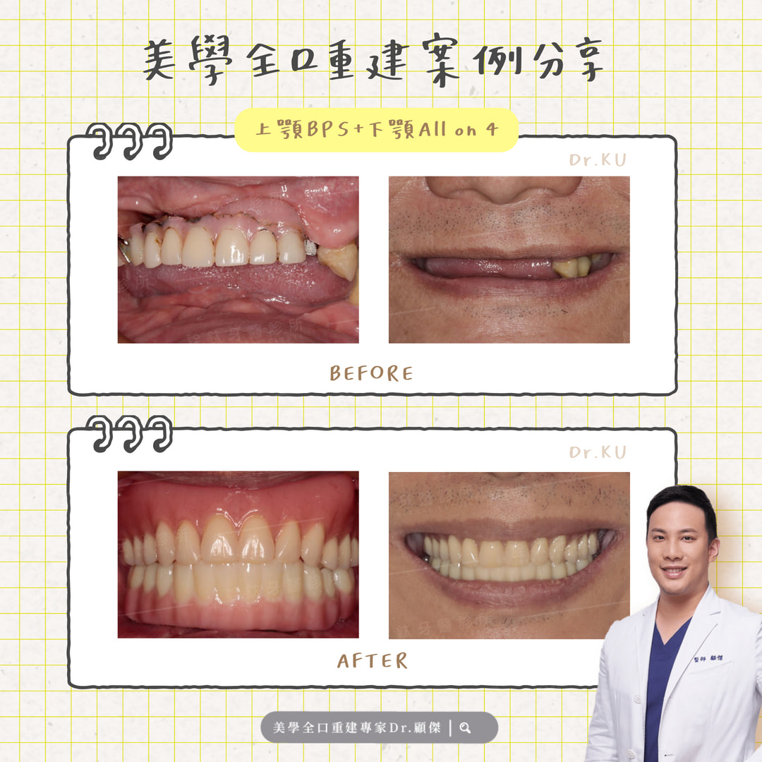 ✨ 美學全口重建案例分享｜L 先生的重生微笑 ✨