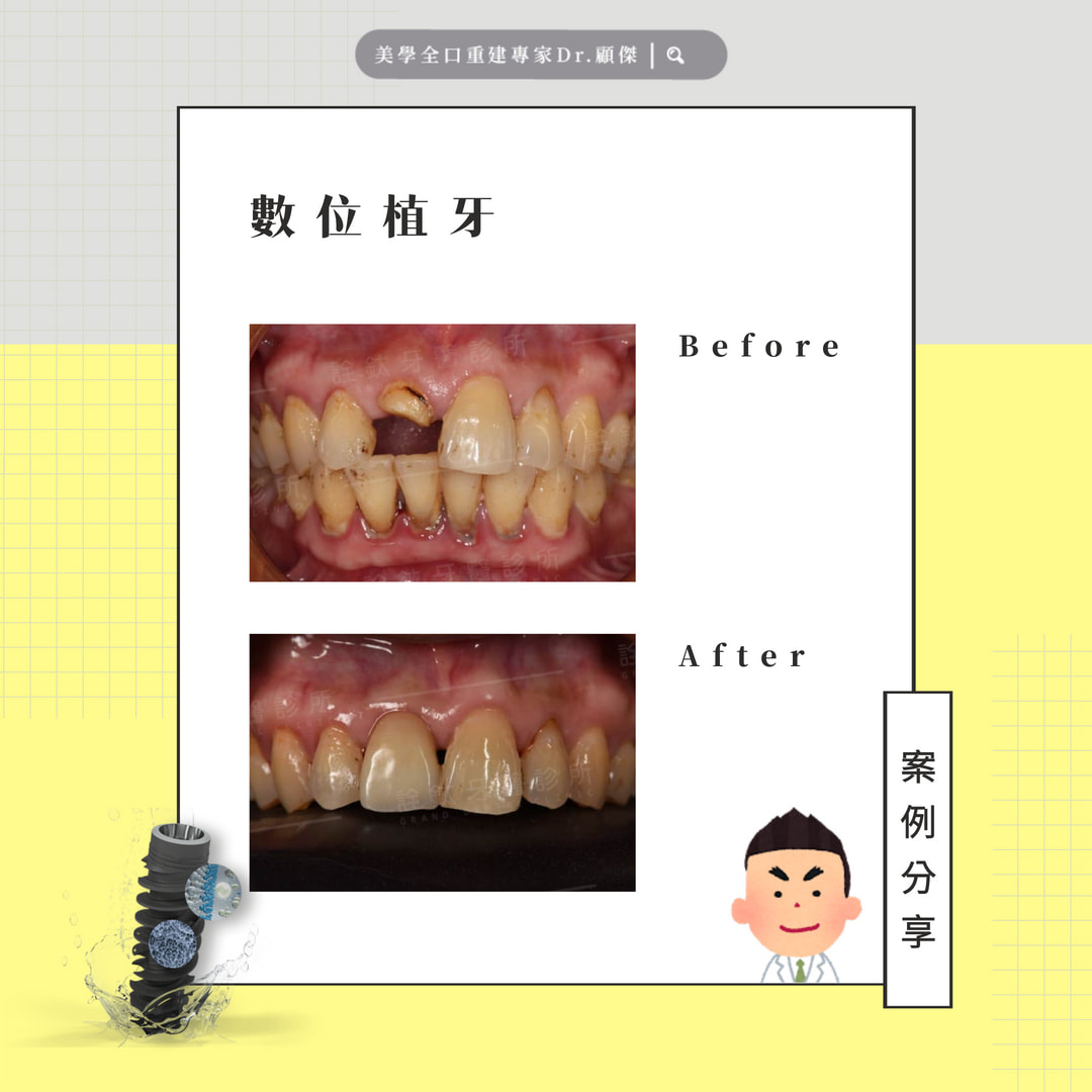 🦷【案例分享｜L小姐的微笑修復之路】