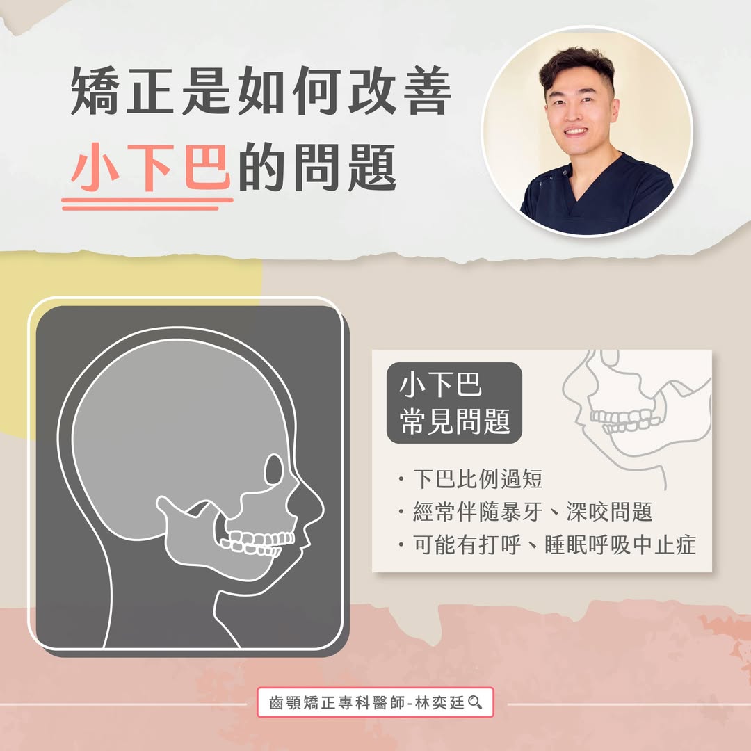 ➤ 矯正是如何改善小下巴的問題