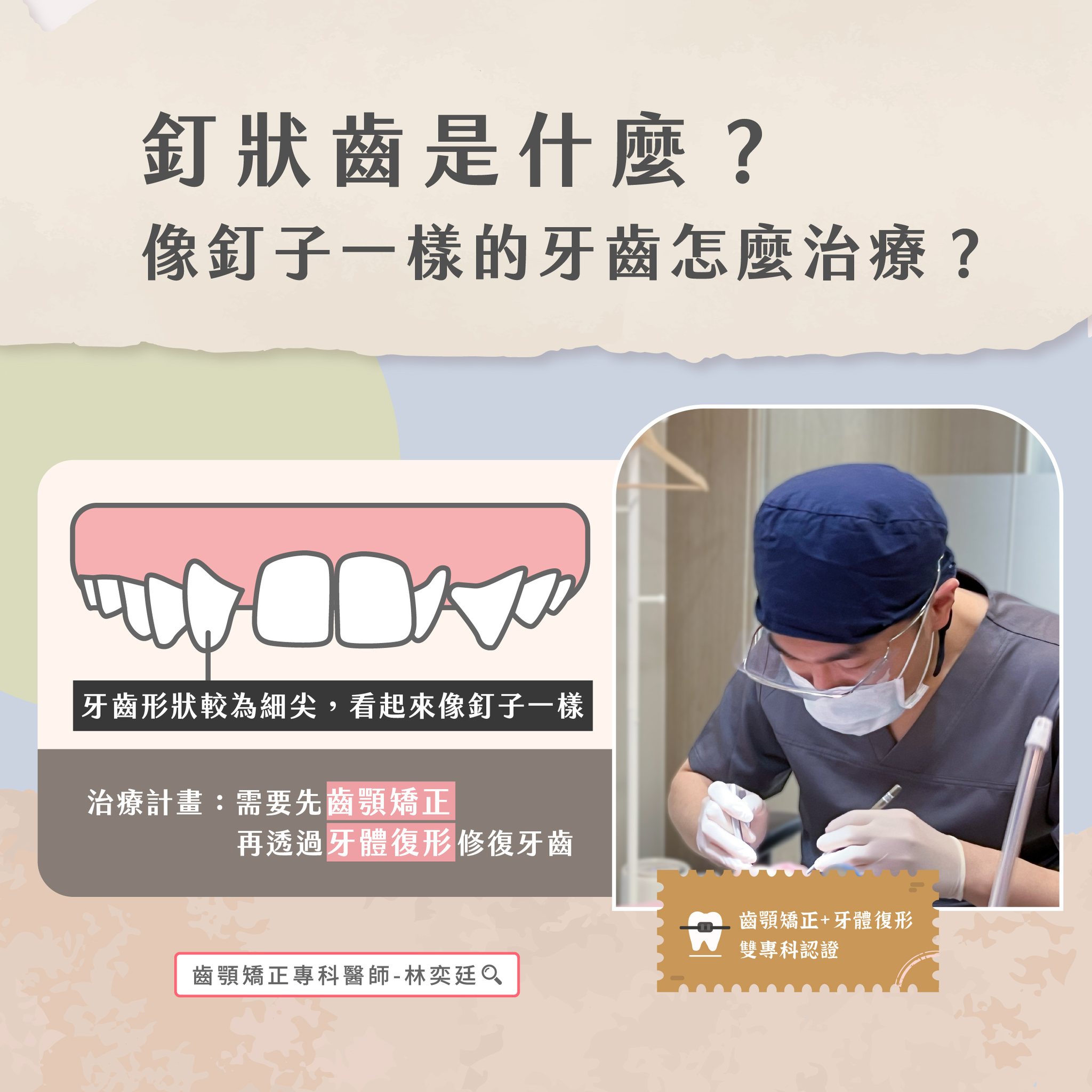 ➤ 釘狀齒是什麼??像釘子一樣的牙齒怎麼治療?