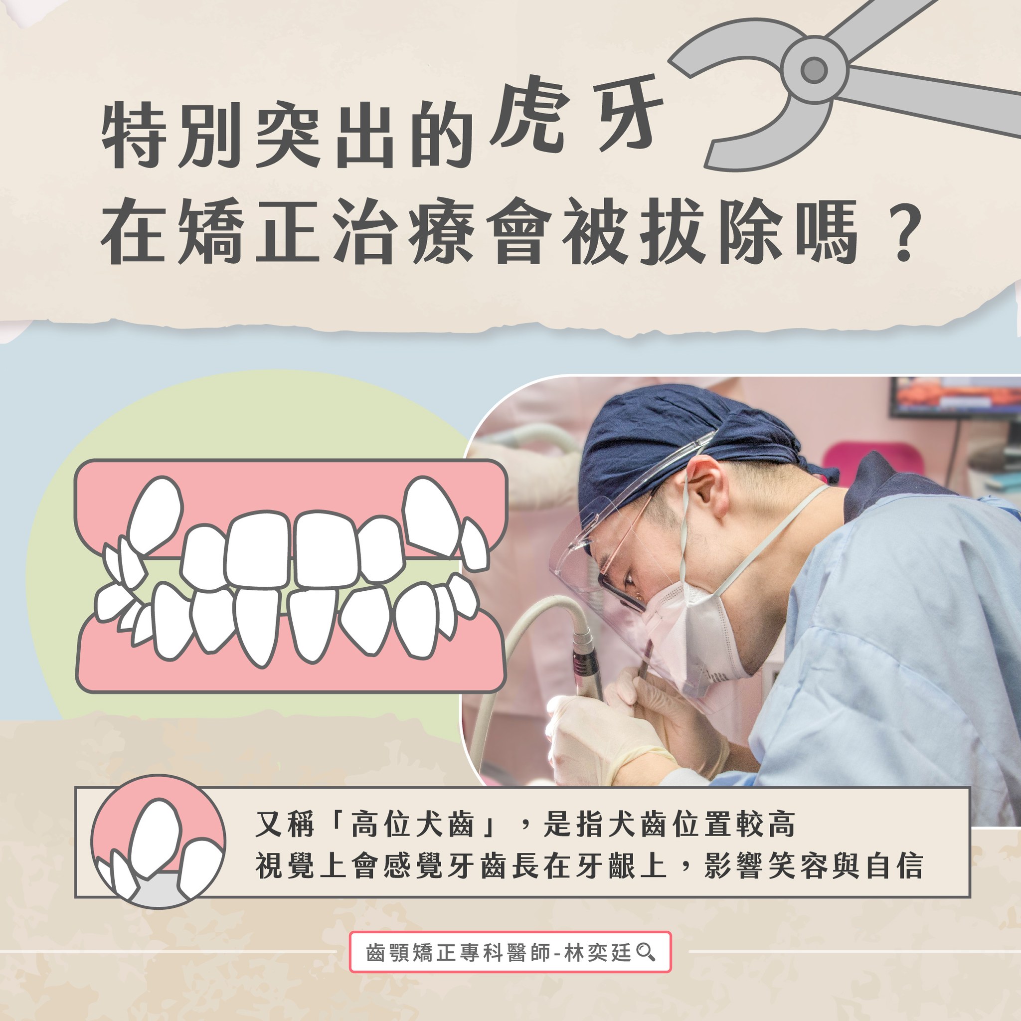 ➤ 特別突出的虎牙,在矯正治療會被拔除嗎?