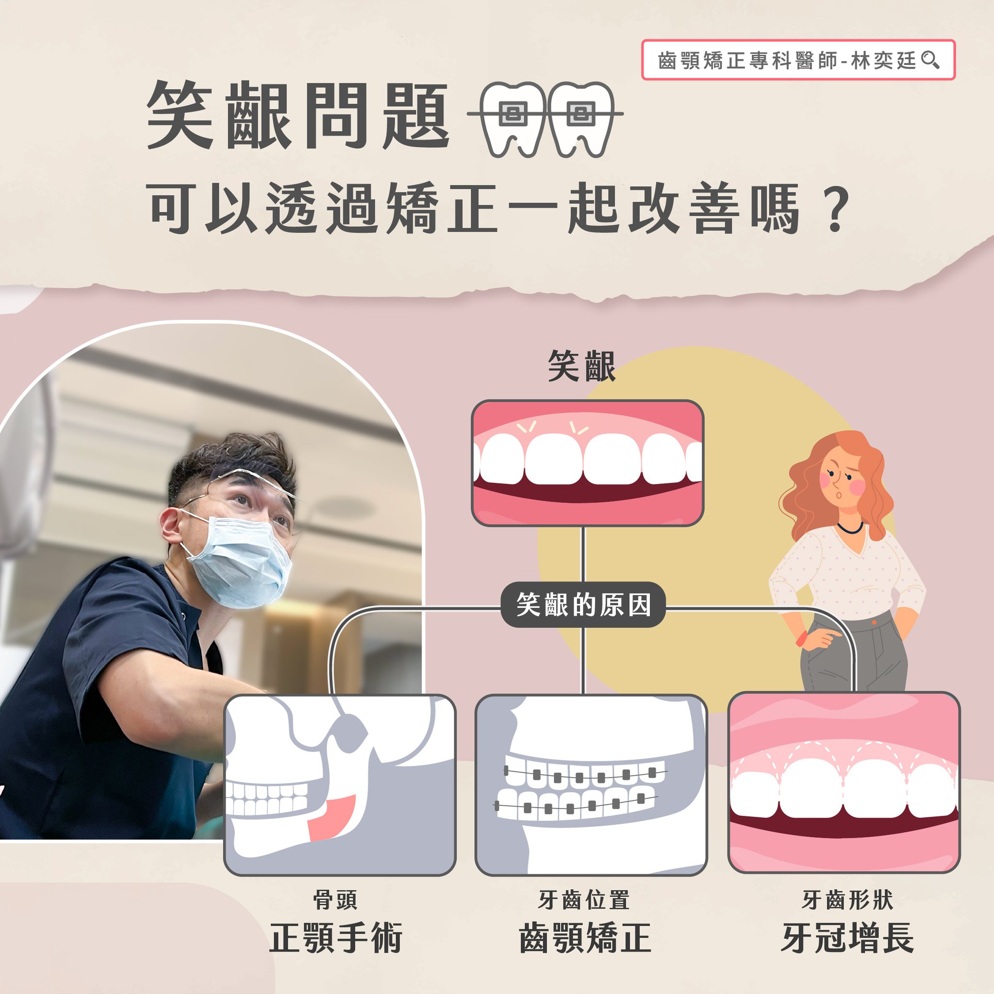 ➤ 笑齦問題可以透過矯正一起改善嗎?