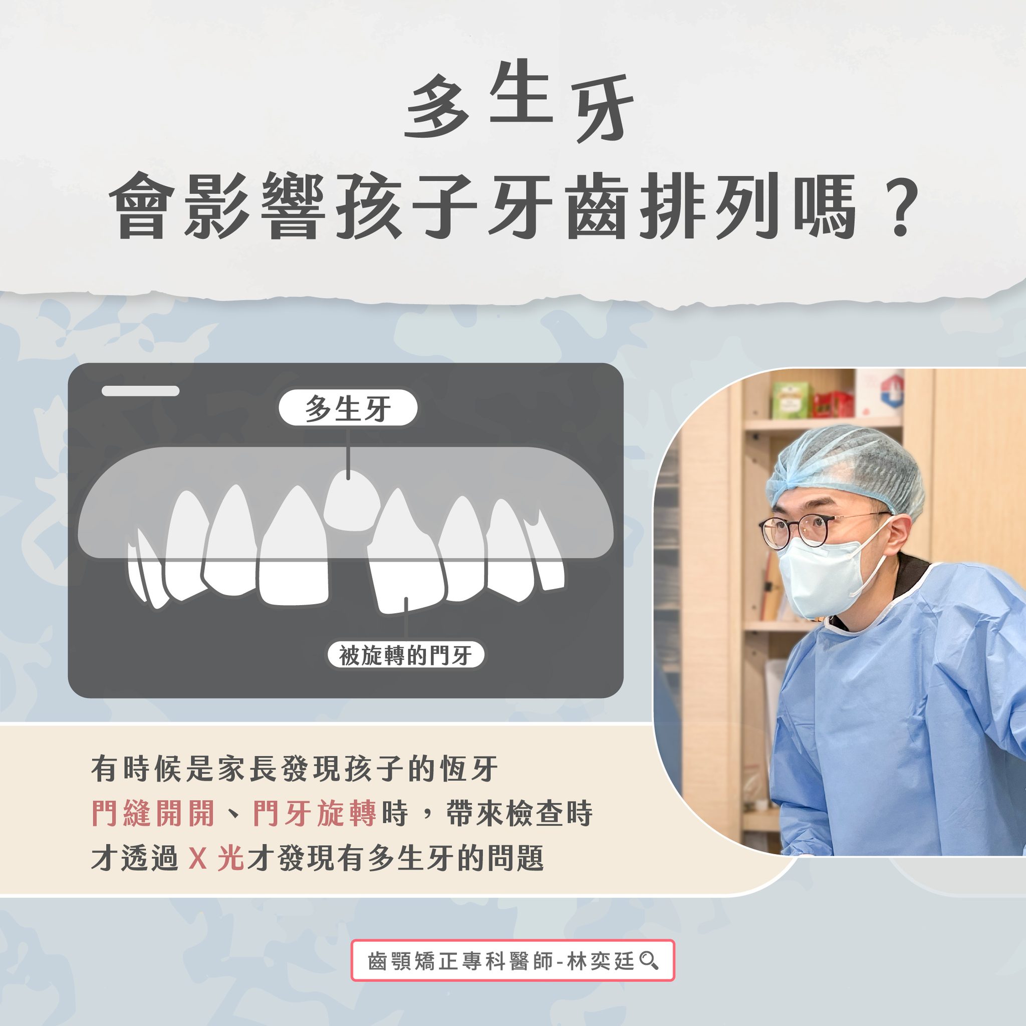 ➤ 多生牙會影響孩子牙齒排列嗎?