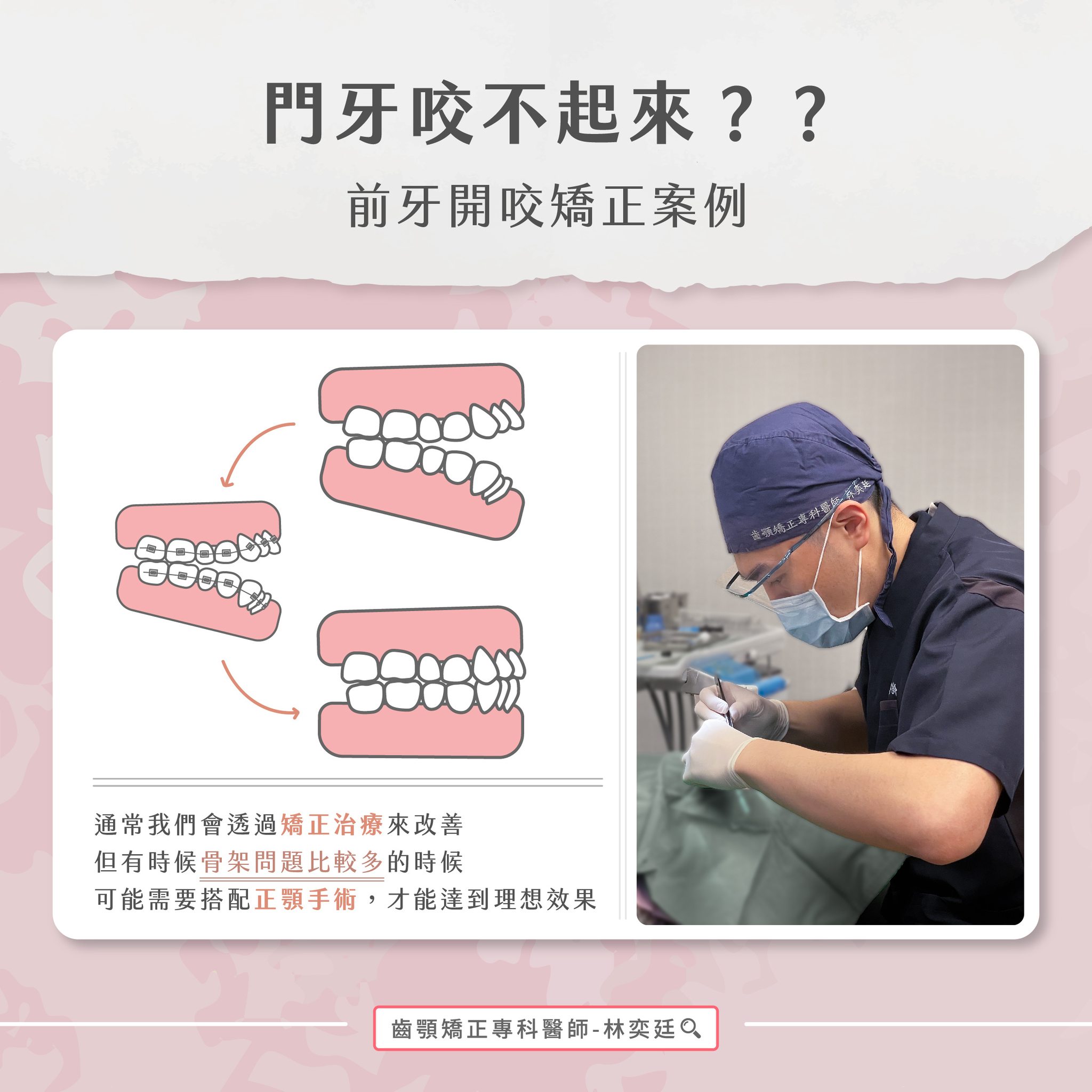 ➤ 門牙咬不起來??前牙開咬矯正案例