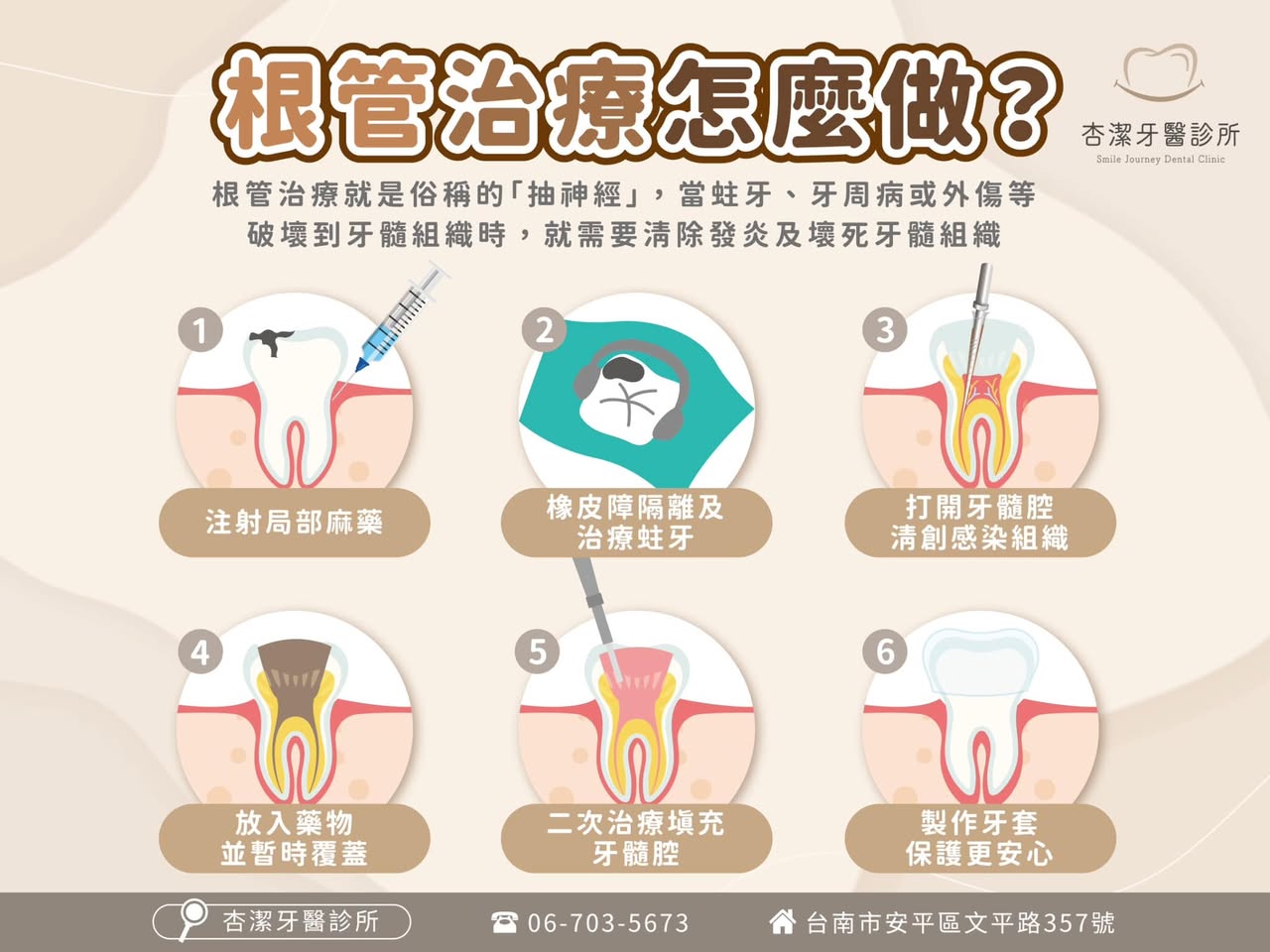 「認識根管治療|守護牙齒健康,找回自信微笑」