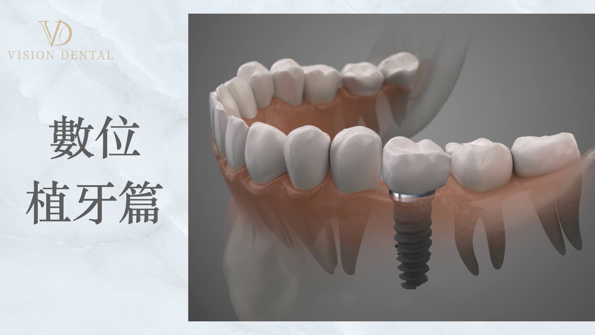 數位植牙案例