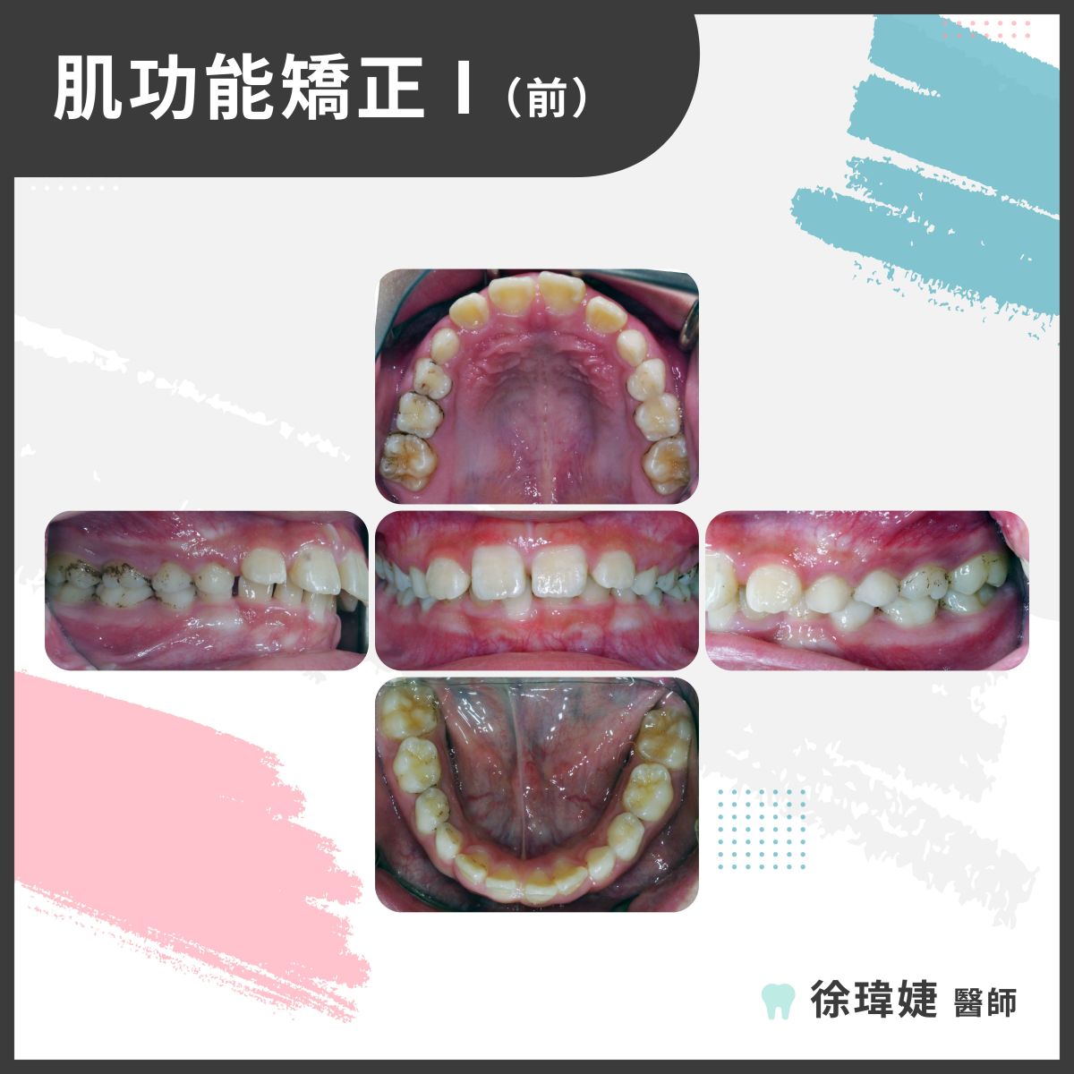 肌功能矯正案例