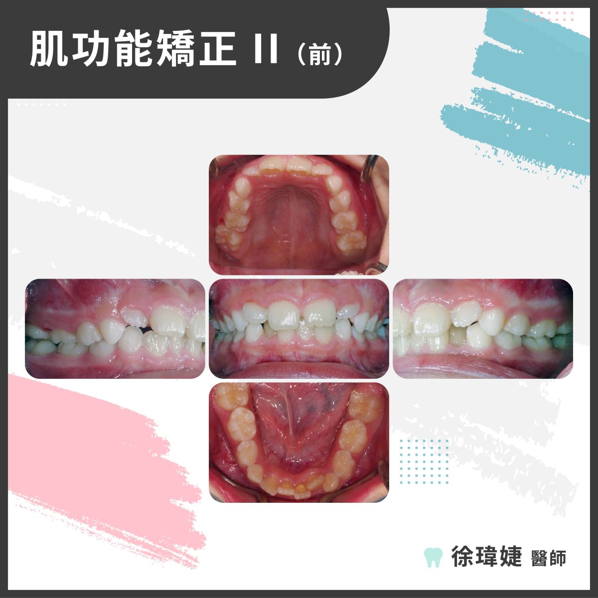 肌功能矯正案例