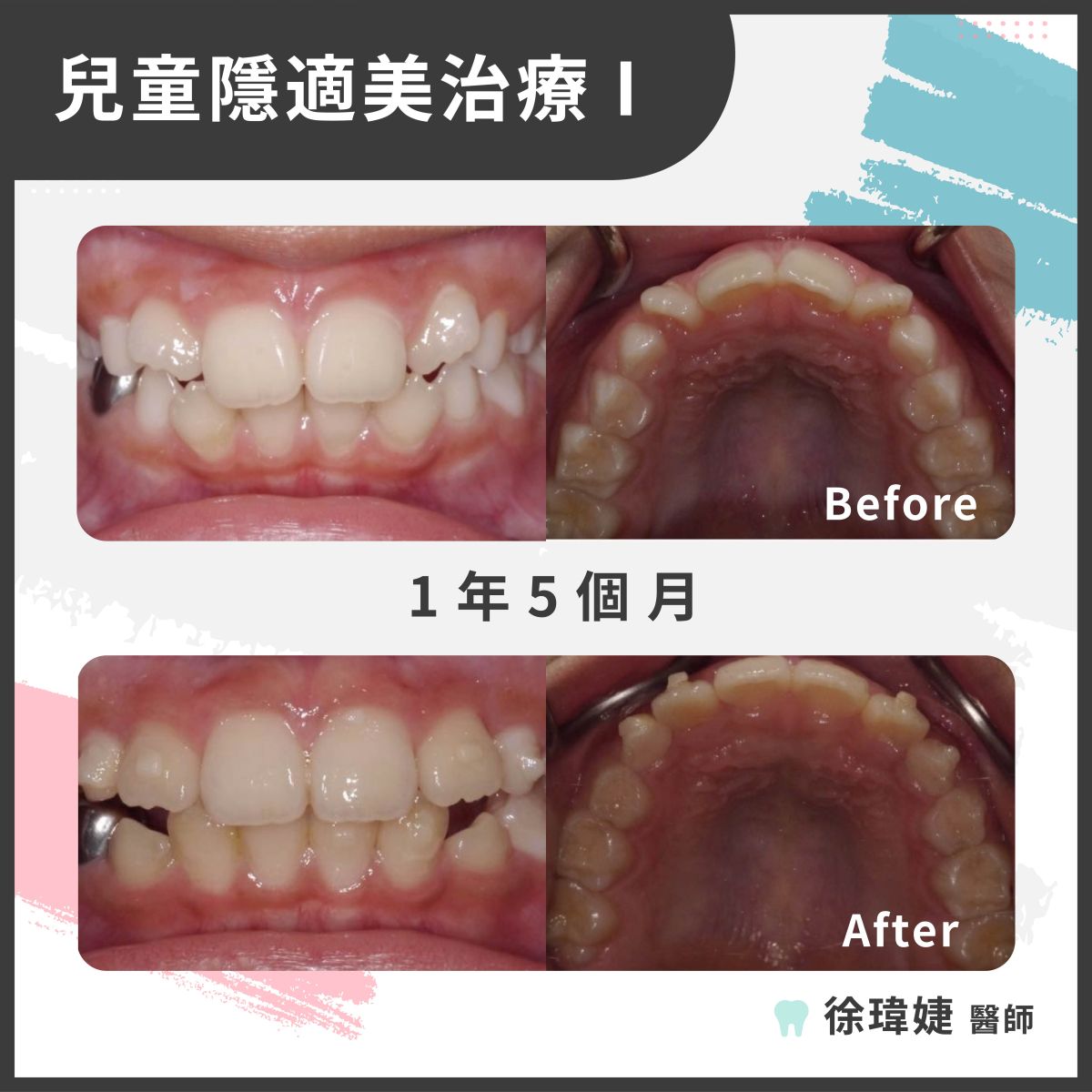 兒童隱適美治療案例