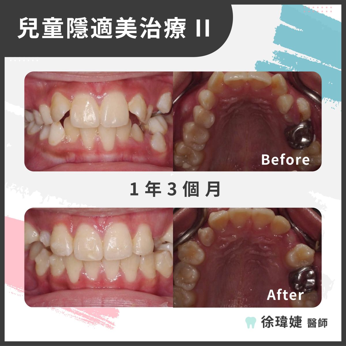 兒童隱適美治療案例