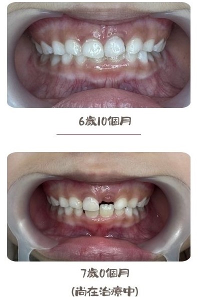 從深咬到健康微笑