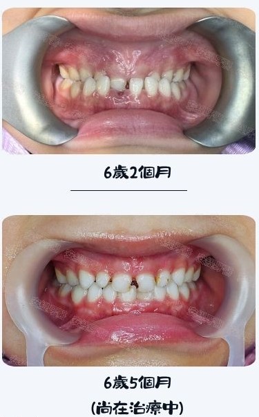 反咬問題,選擇肌肉功能矯正器輔助改善