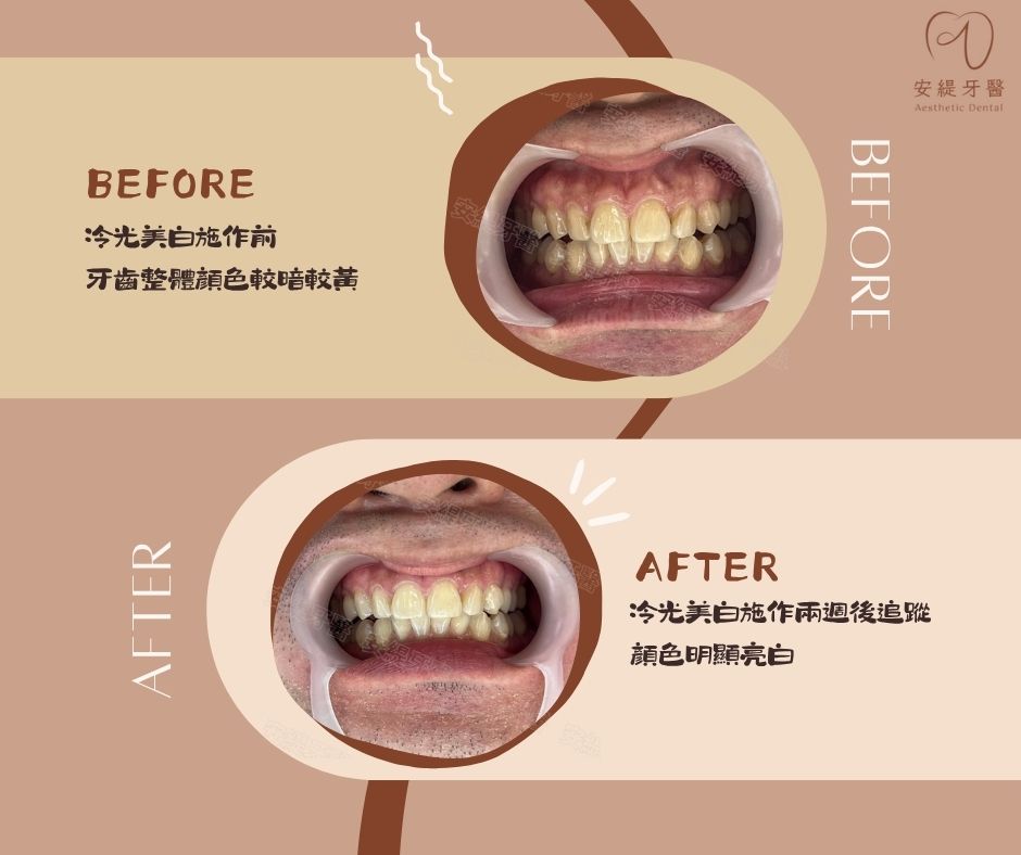 冷光美白