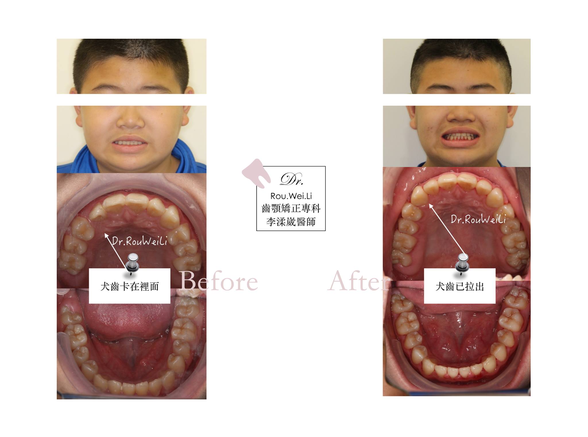當小孩牙齒長不出來時