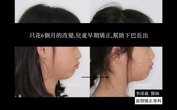 花6個月,改善下巴內縮和牙齒凌亂