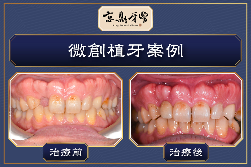 微創植牙案例