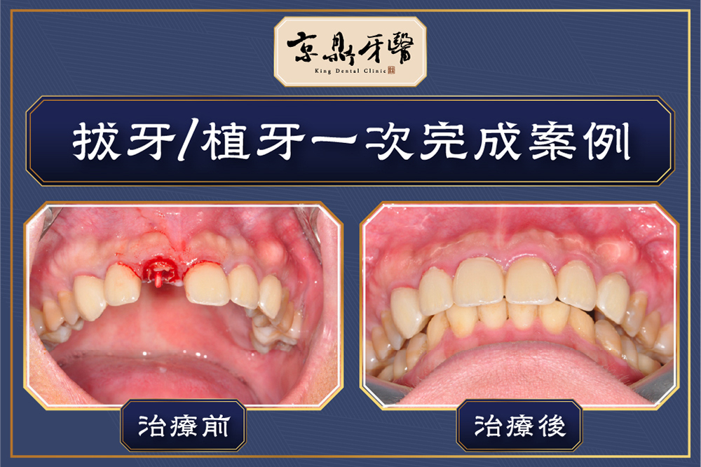 拔牙植牙一次完成案例