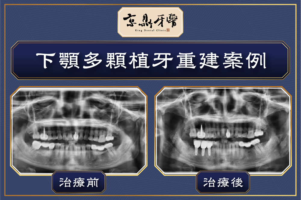 下顎多顆植牙重建案例