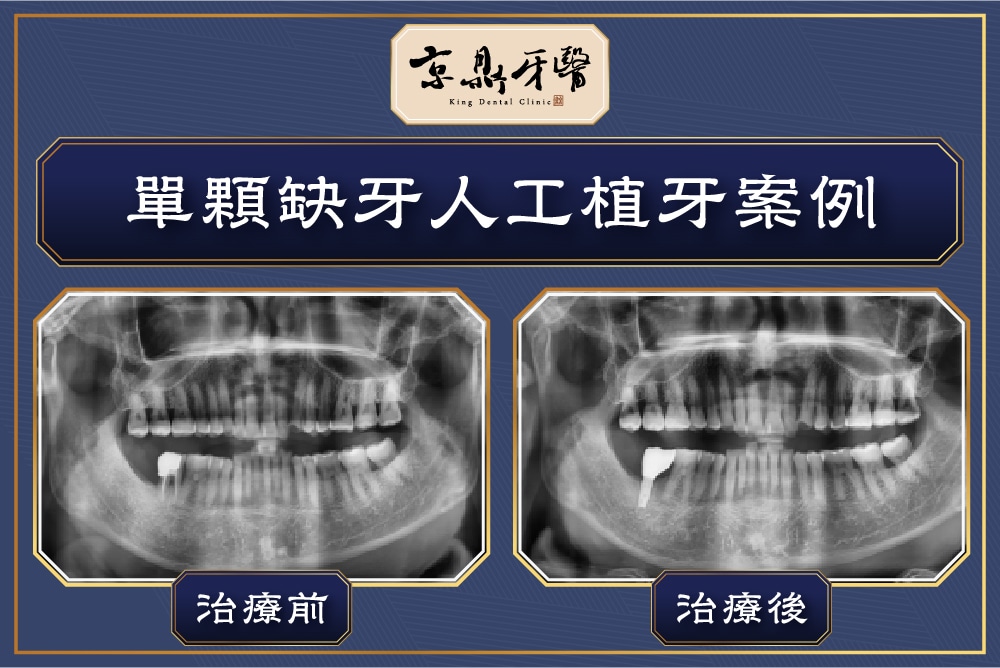 單顆缺牙人工植牙案例