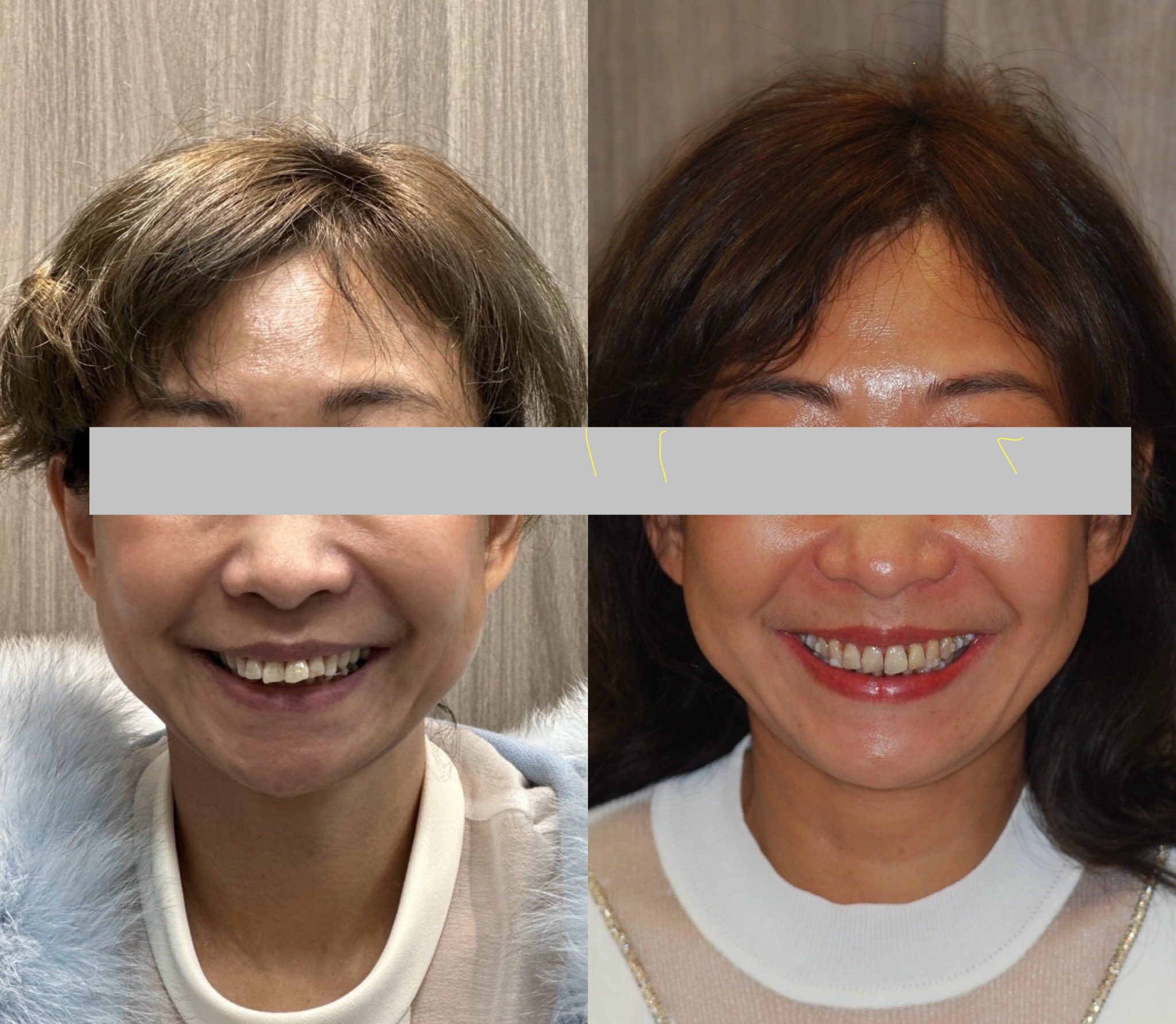 重度牙周病案例分享