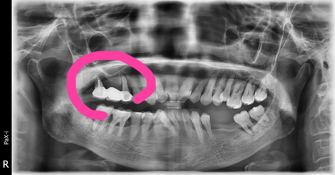 重度牙周病案例分享
