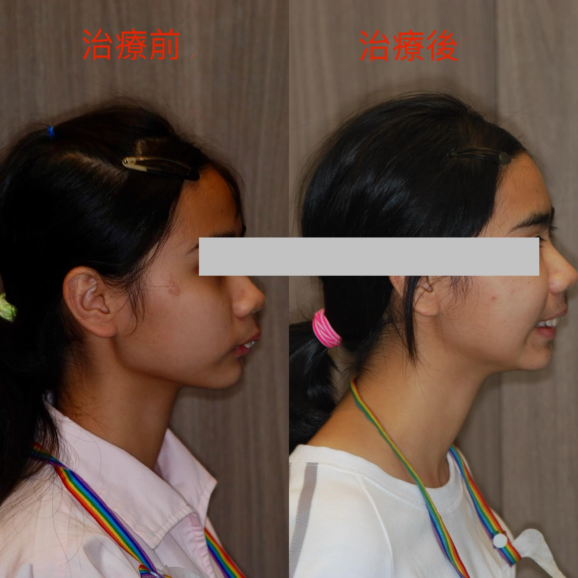 隱適美也能進行功能性矯正?