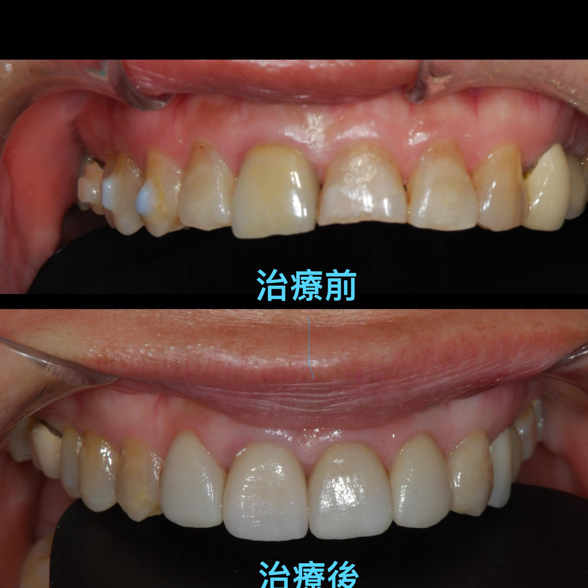 牙周病案例分享