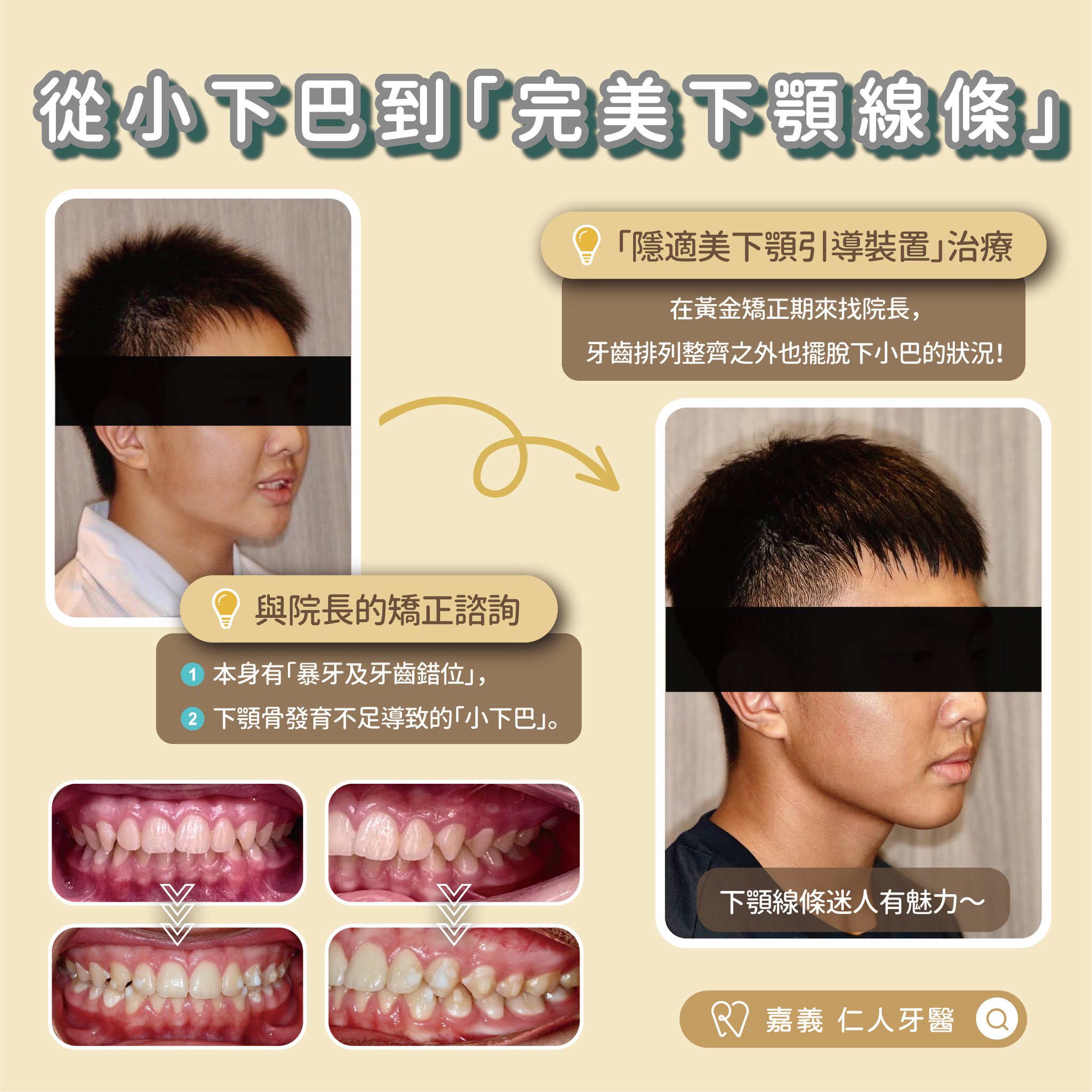 隱適美從小下巴到「完美下顎線條」
